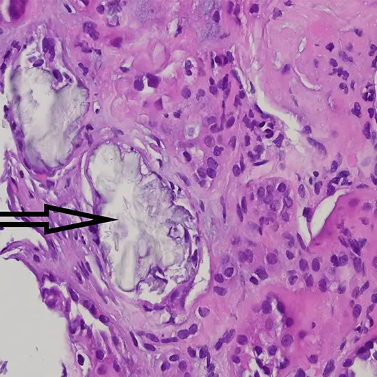 histopathology kidney biopsy panel 1 test